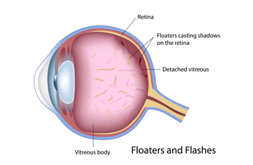 Flashes And Floaters Treatment Toronto Herzig Eye Institute